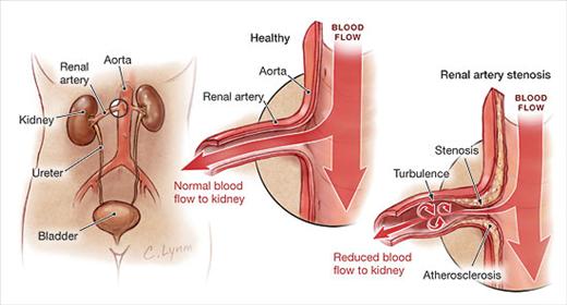Viêm động mạch - Hình ảnh minh họa